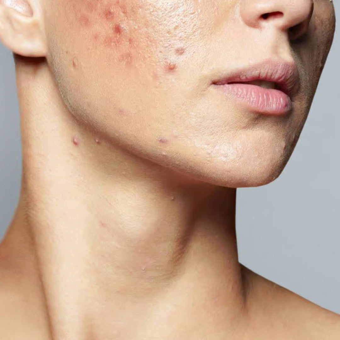 Professional Chameleon Peel treatment improving skin texture in clinic – DR.MESO Canada
