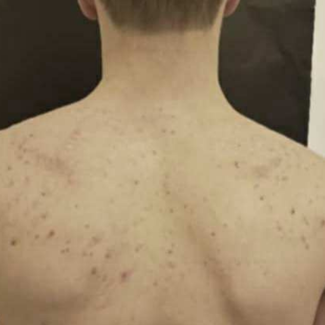 TRIPLE ACTION BODY CREAM - ACNE PRONE