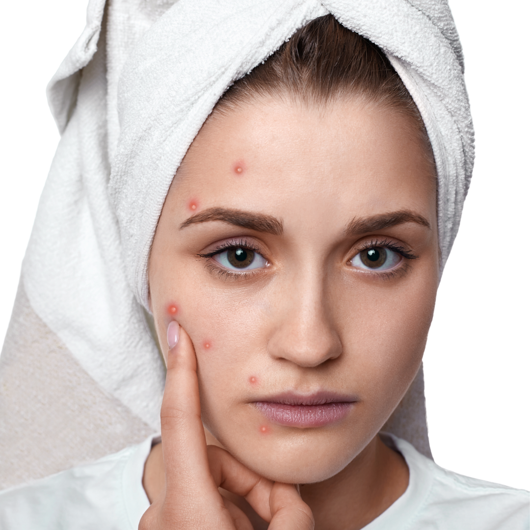 CLEANSING GEL - ACNE PRONE