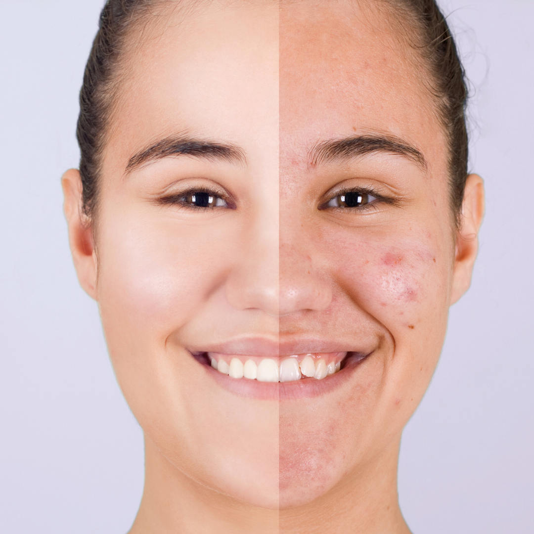 Acne scars and pigmentation treatment results with Chameleon Peel.