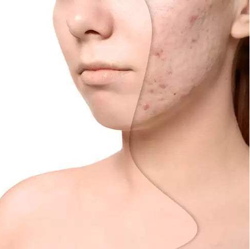 Complete acne skincare set – holiday special offer Canada