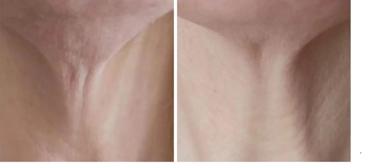 DR.MESO LIFTOX before and after appearance of neck skin texture