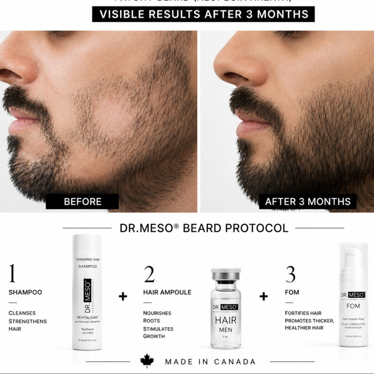 BEARD RESTORATION FOR MEN
Visible Results After 3 Months