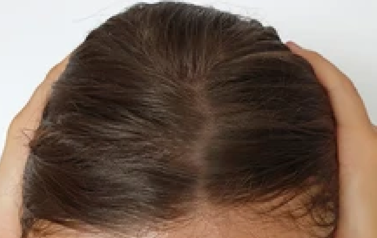 Close-up of a person's head with hair loss on a plain background



