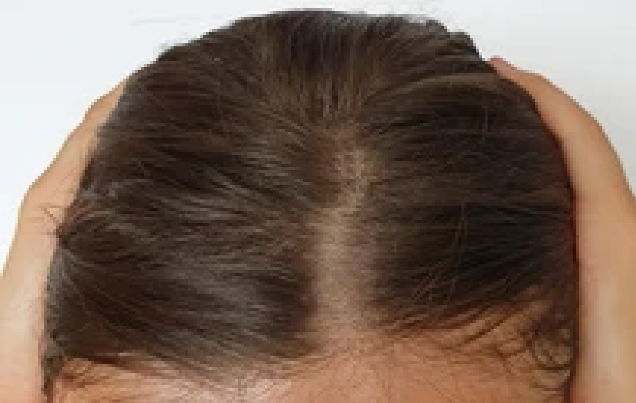 Close-up of a person's head with hair loss on a plain background
