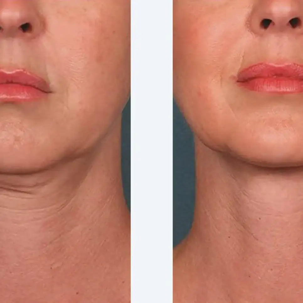 Before and after comparison of a woman's neck area with visible skin texture differences after using Dr. Meso